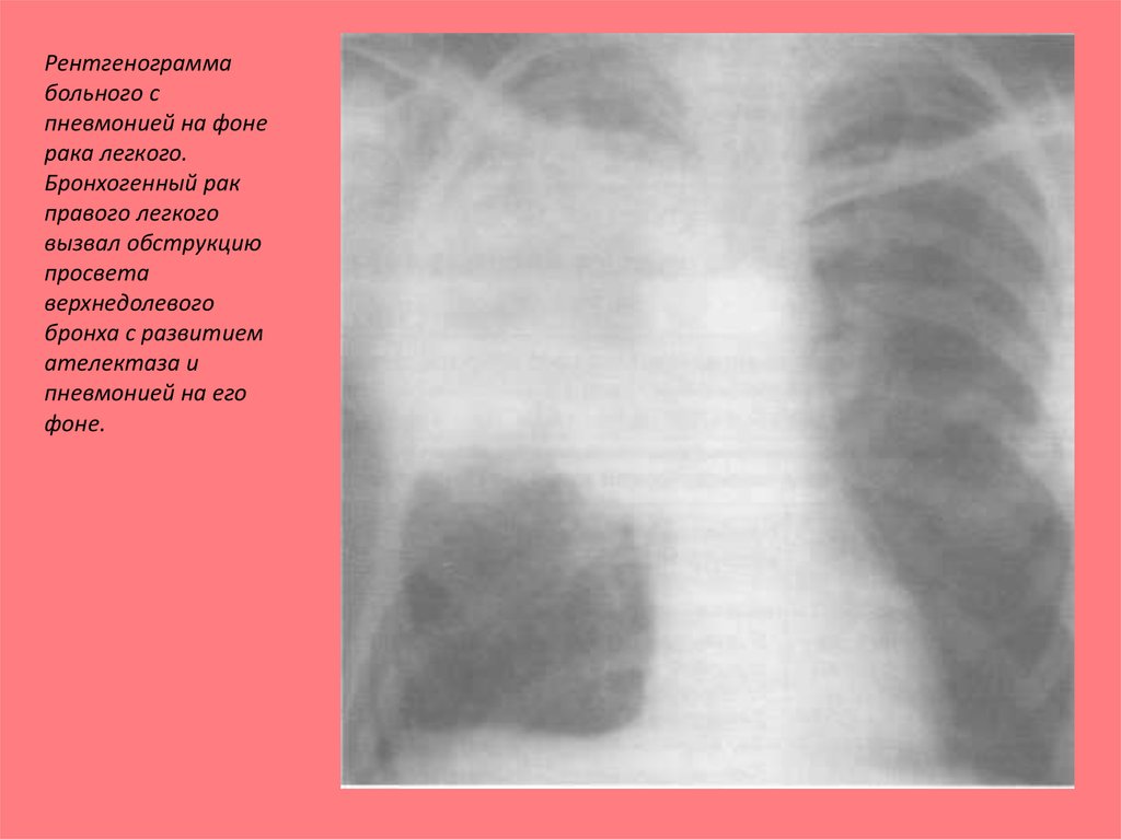 Вызывали легкие. Рентгенограмма больного с пневмонией. Пневмония вызванная клебсиеллой рентген. Бронхогенная карцинома. Пневмония на фоне онкологии.