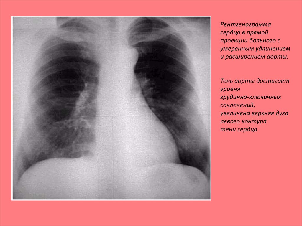 Тень сердца расширена. Сердце в прямой проекции на рентгенограмме. Дуга аорты на рентгенограмме. Тень сердца на рентгенограмме. Расширение тени сердца на рентгенограмме.