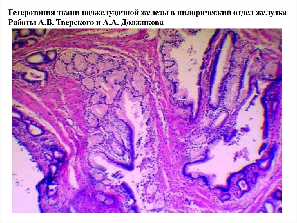 Эктопия железы. Эктопия поджелудочной железы гистология. Ткань поджелудочной железы гистология. Эктопия поджелудочной железы в желудок гистология. Железы поджелудочной железы гистология.