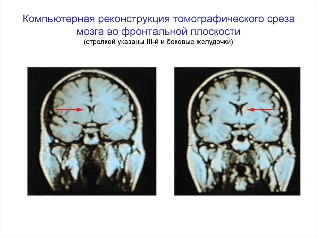 Итеративная реконструкция кт изображений