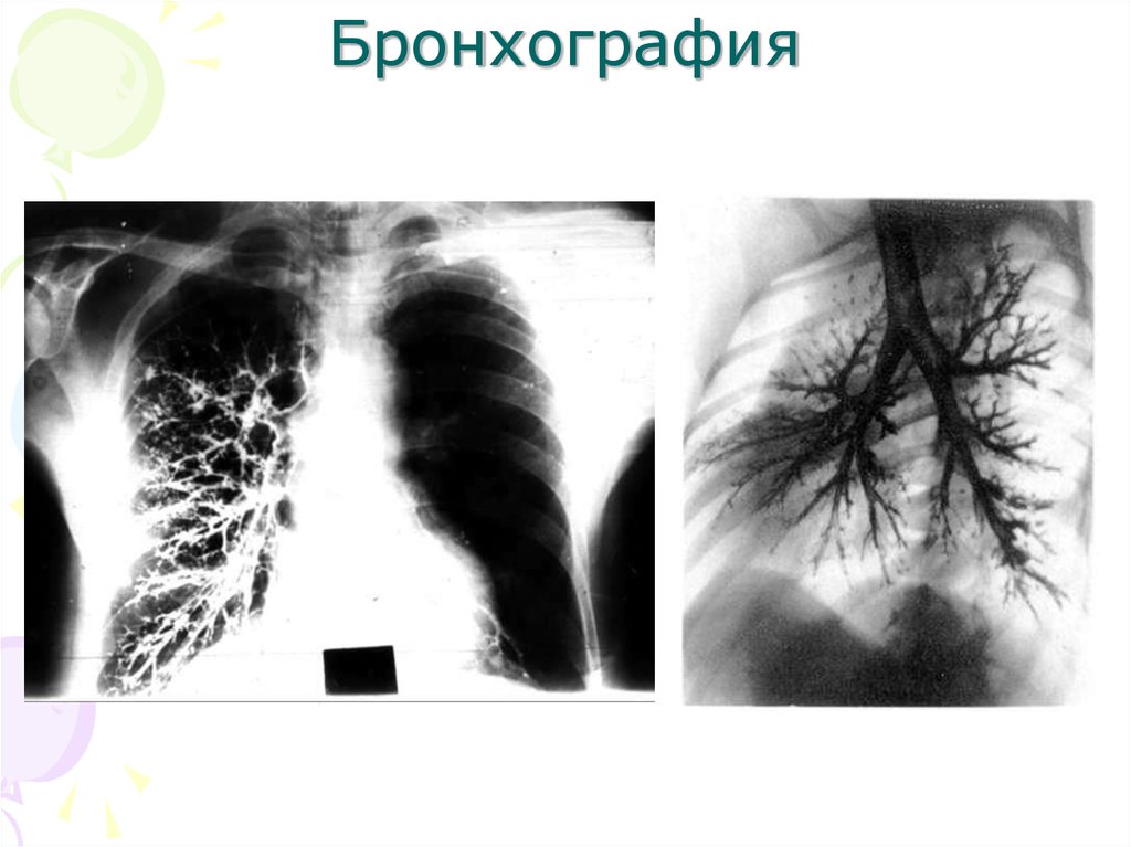 Бронхография. Бронхография патология. Хронический бронхит бронхография. Бронхография пневмония. Бронхография бронхоэктазы.