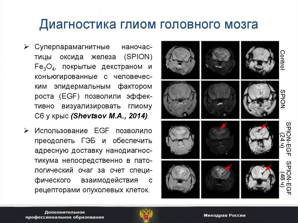 Диагноз опухоли головного. Глиоматоз головного мозга Продолжительность жизни. Глиома мозгового ствола. Глиома ствола мозга мрт.
