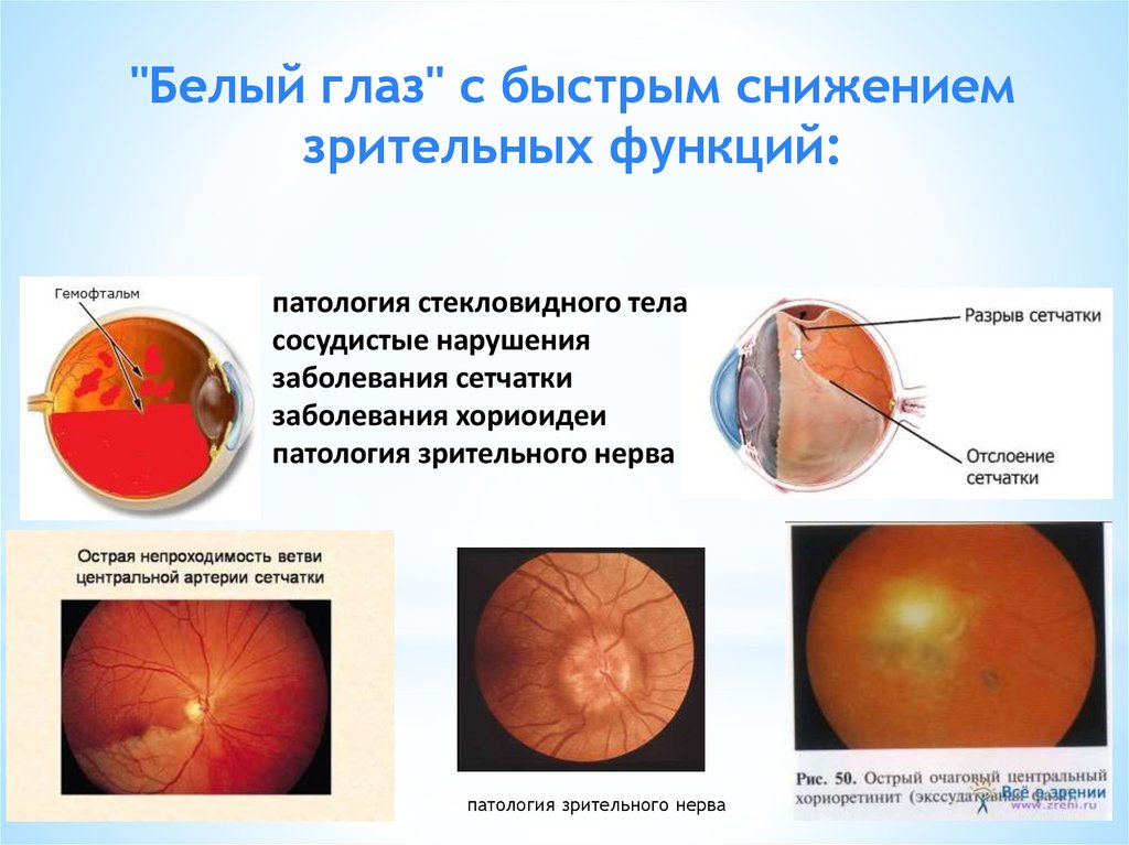 Реферат: Литература - Офтальмология (синдром белого глаза с быстрым снижением