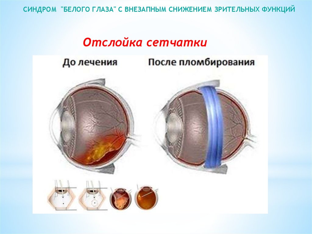 Реферат: Литература - Офтальмология (синдром белого глаза с быстрым снижением