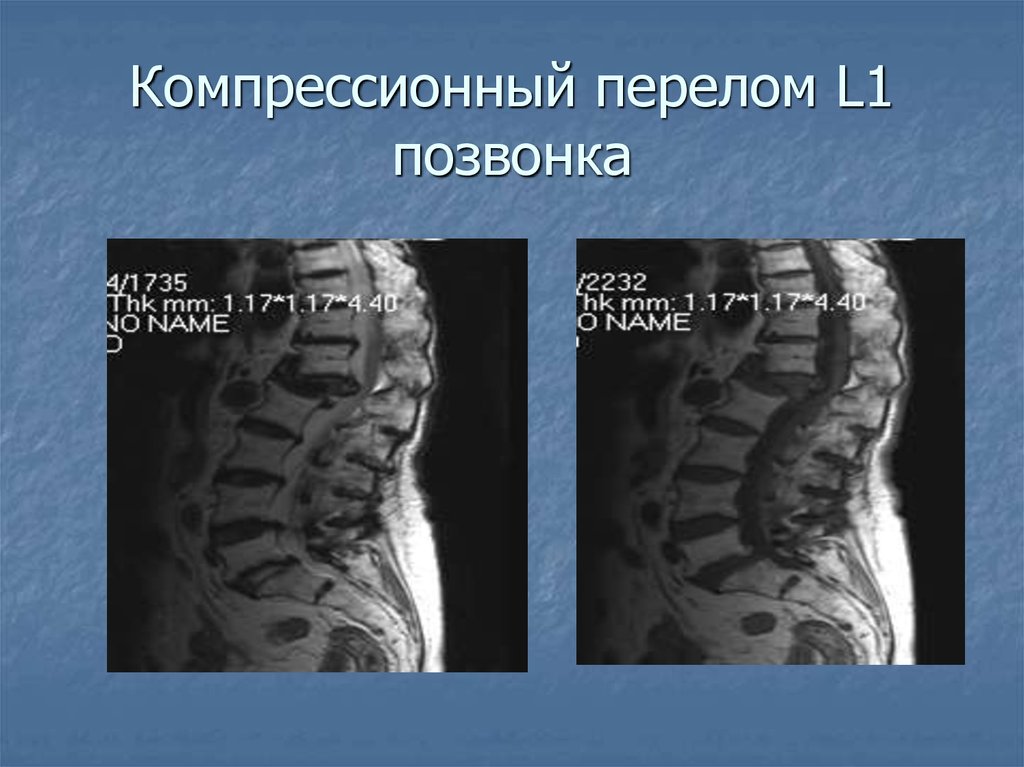 Лечение последствия компрессионного перелома позвоночника. Компрессионный перелом позвоночника л1. Компрессионный перелом позвоночника th11-l1. Компрессионный перелом л 1. Компрессионный перелом в пояснице позвонка l1.