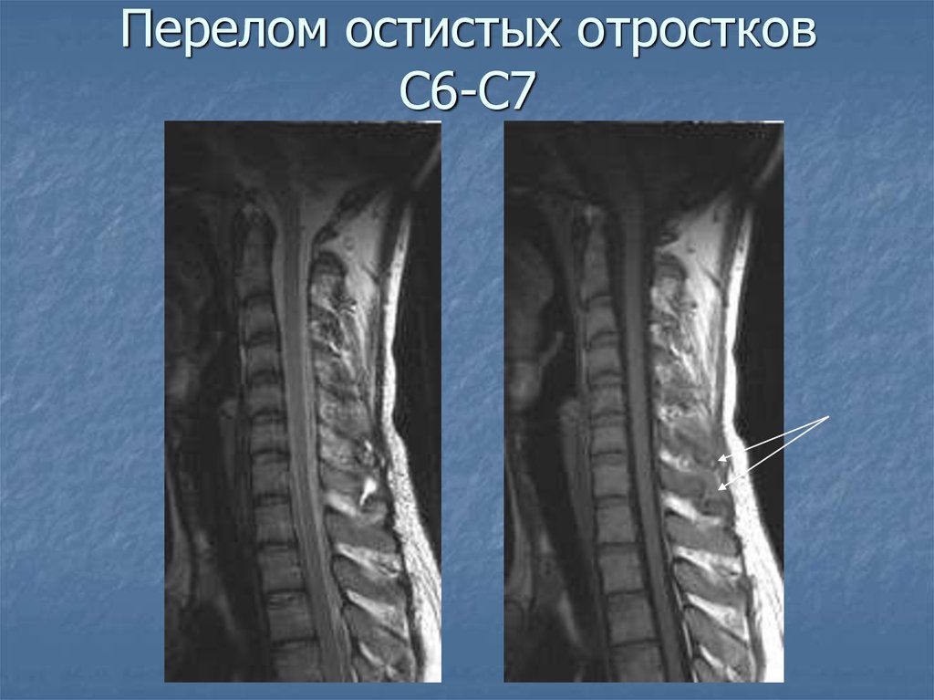 Перелом остистого отростка