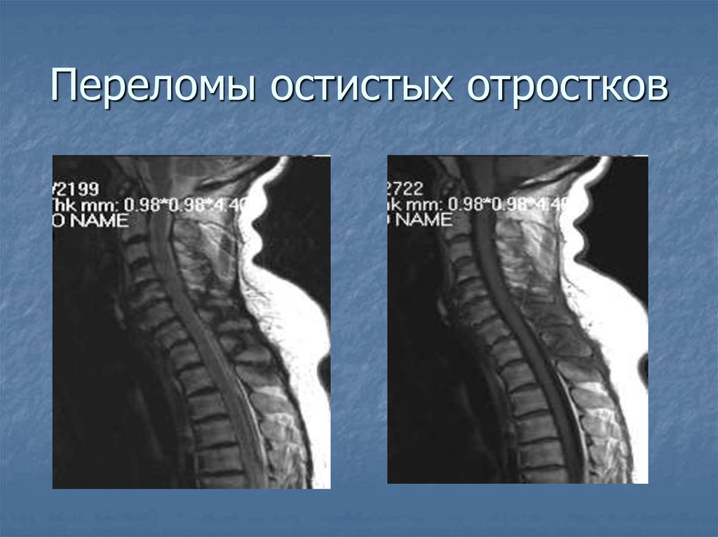 Последствие перелома позвоночника мкб. Перелом остистого отростка l5 позвонка. Перелом остистого отростка мрт. Перелом остистого отростка 7 позвонка. Остистый отросток l3 позвонка.