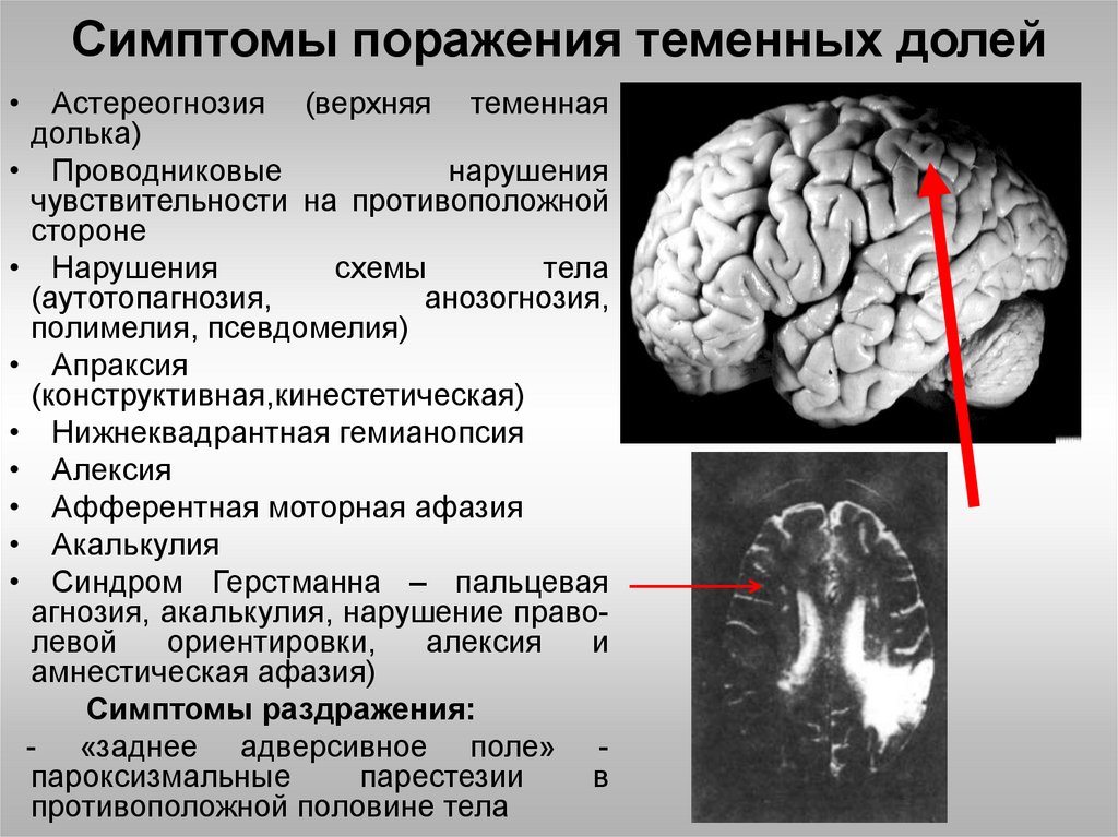 Корковые изменения головного мозга. Синдромы поражения теменной доли. Симптомы поражения теменной доли мозга. Синдром теменной доли неврология. Симптомы поражения коры лобной доли головного мозга.