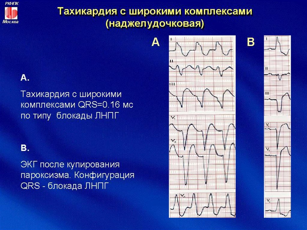 Экг при тиреотоксикозе картинки