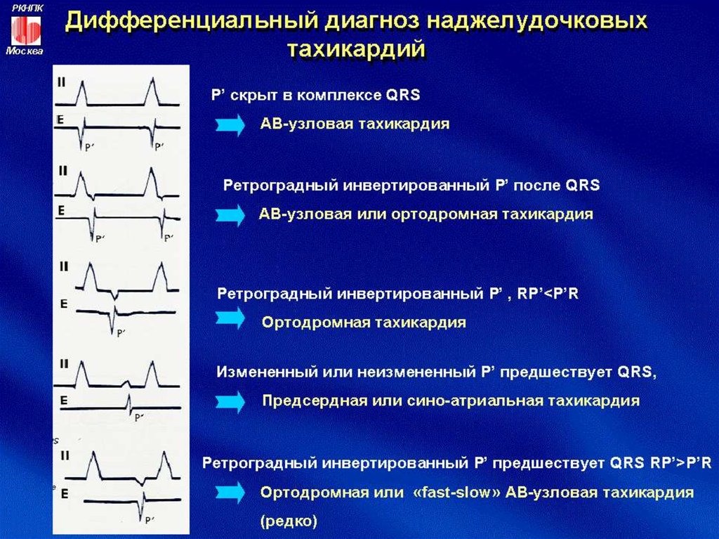 Наджелудочковые тахикардии по утвержденным клиническим рекомендациям