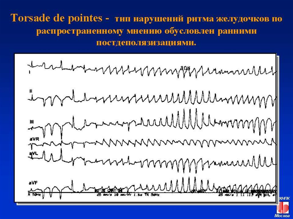 Нарушения ритма презентация