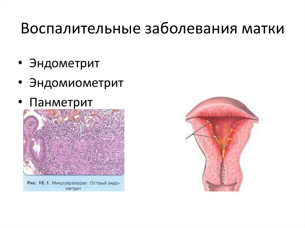 Воспаление матки. Воспалительные заболевания матки. Невоспалительные заболевания матки. Эндометрит гинекологический. Воспалительный эндометрит.