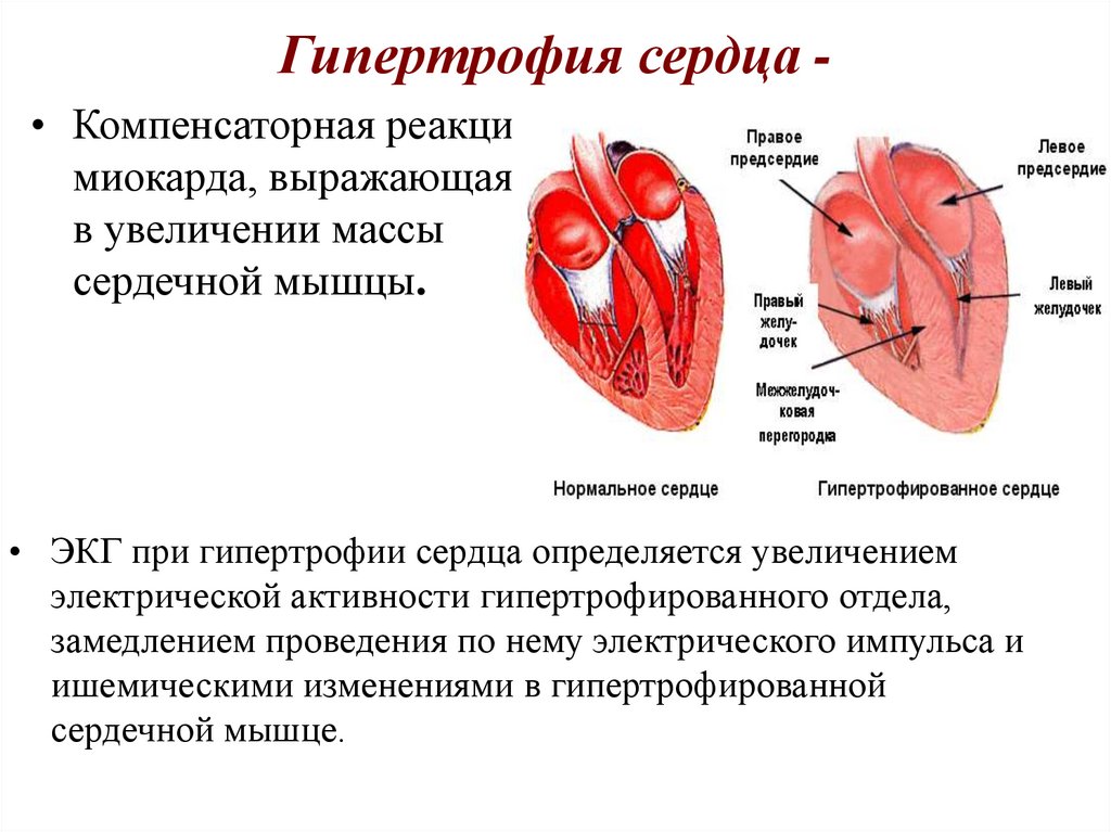 Миокард правого предсердия. Гипертрофия левых отделов. Гипертрофия миокарда желудочков. Гипертрофия миокарда левого желудочка осложнения. Гипертрофия левых отделов сердца.