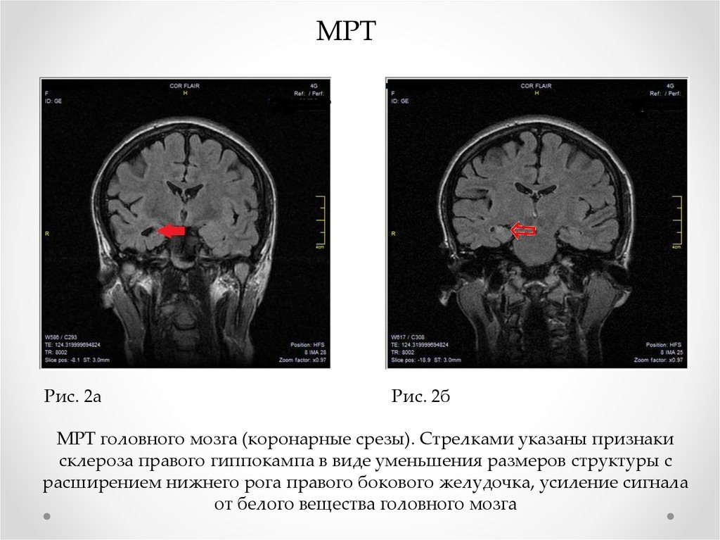 Темпоральный склероз. Гиппокамп мозга кт. Склероз гиппокампа мрт. Склероз гиппокампов на мрт. Мезиальный склероз мрт.