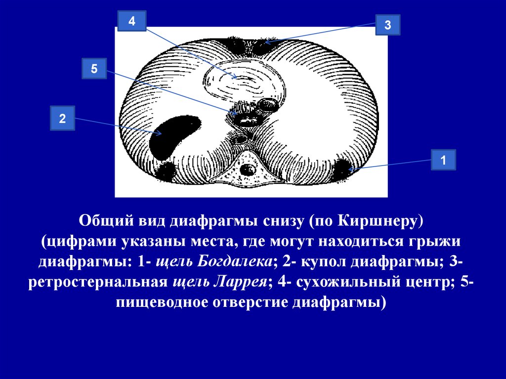 Грыжа бохдалека. Грыжи диафрагмы Морганьи. Грыжи диафрагмы Бохдалека. Грыжи диафрагмы Богдалека на кт.