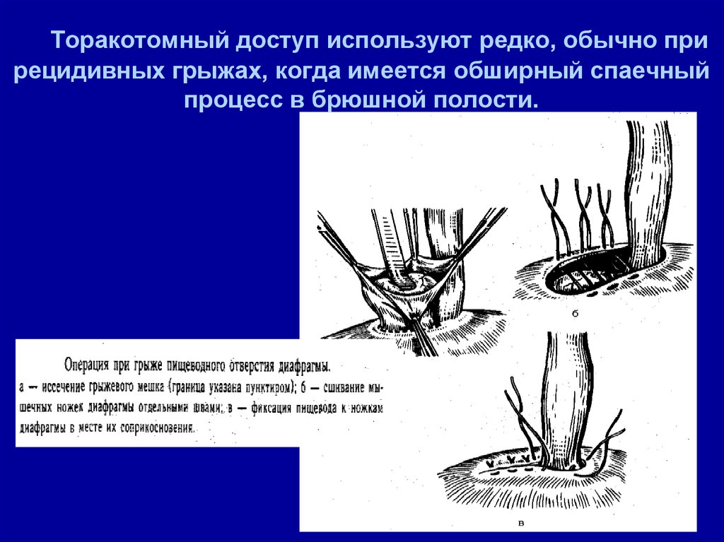 Диафрагмальные грыжи у детей презентация