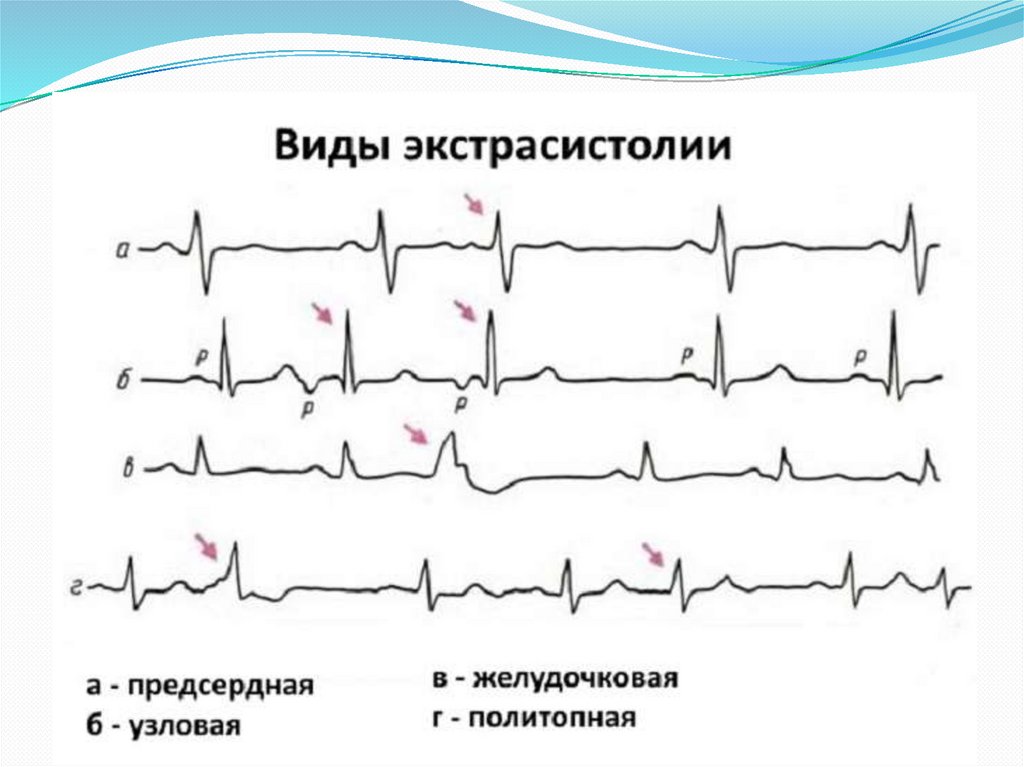 Экстрасистолы 4. ЭКГ монотопные желудочковые экстрасистолы. Схема ЭКГ экстрасистола. Виды желудочковых экстрасистол на ЭКГ. Желудочковая экстрасистолия на ЭКГ.