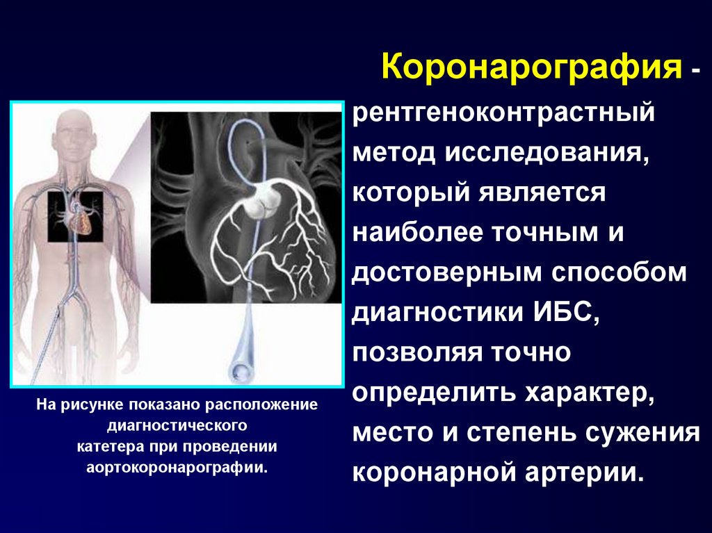 Что такое коронарография. Рентгеноконтрастная коронарография. Коронарография методика. Коронароангиография методика. Метод исследование коронарография.