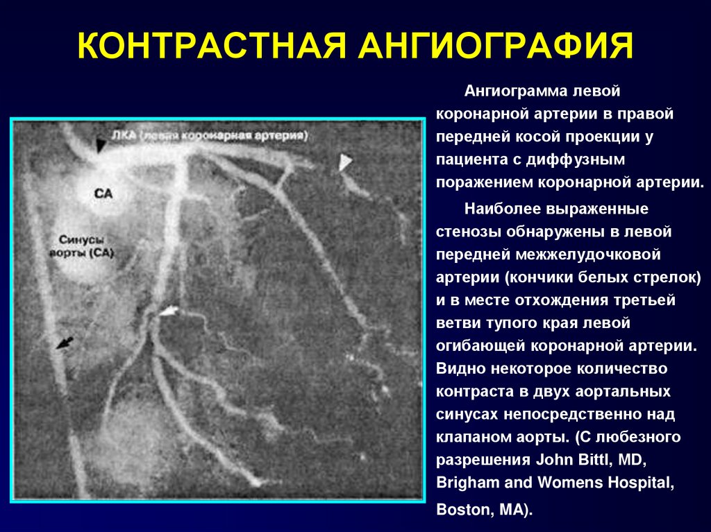 Стеноз артерий сердца. Стеноз почечной артерии ангиограмма. Контрастная ангиография. Контрастная краниография. Правая коронарная артерия ангиограмма.