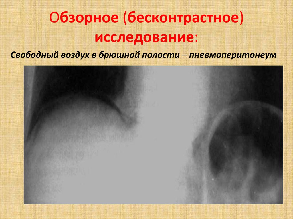 Исследование свободного. Бесконтрастное исследование брюшной полости. Бесконтрастная рентгенография. В условиях бесконтрастного исследования. Свободный воздух брюш.