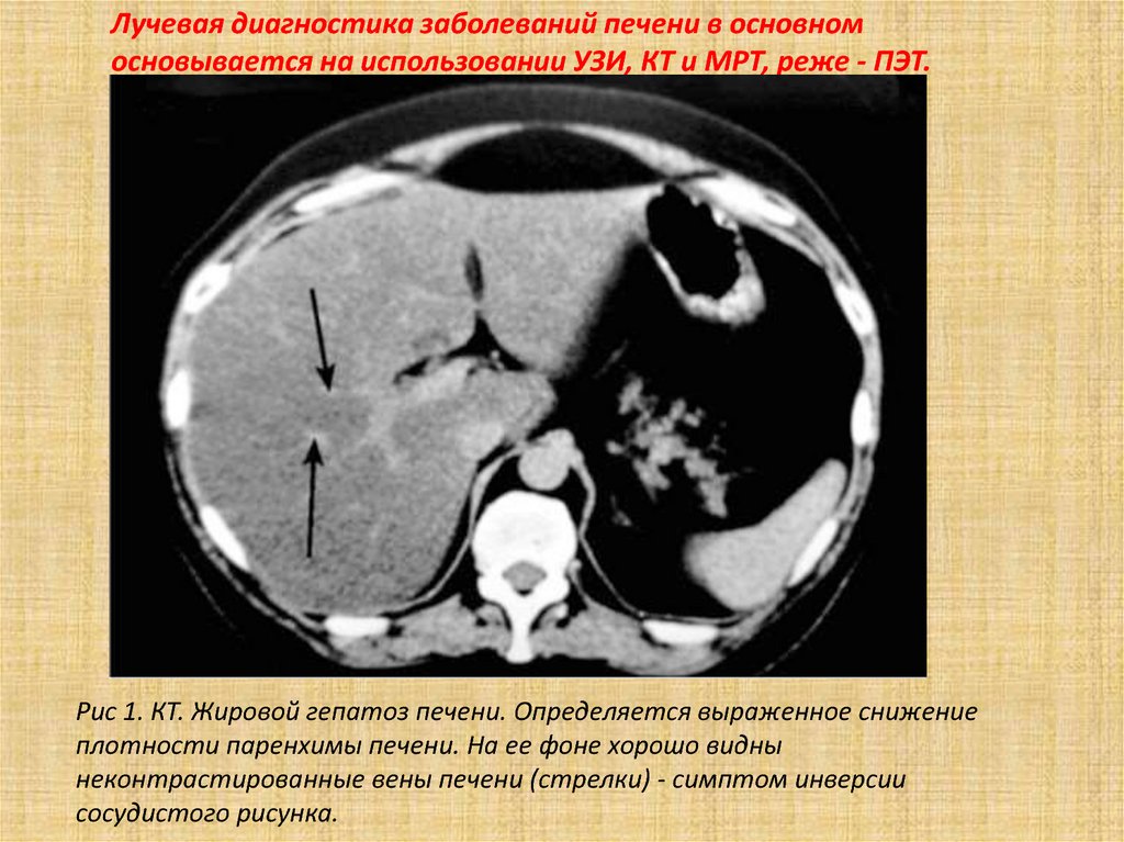 Лучевой диагноз. Кт признаки жирового гепатоза. Очаговый жировой гепатоз кт. Жировой гепатоз печени на кт. Фокальный жировой гепатоз печени кт.