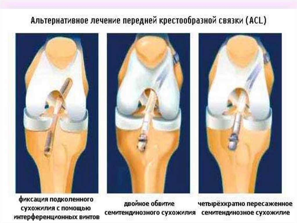 Лечение передних