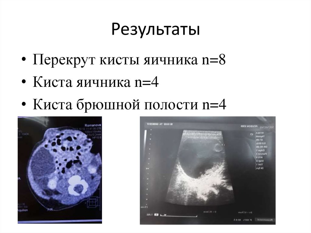 Перекрут ножки кисты яичника карта вызова