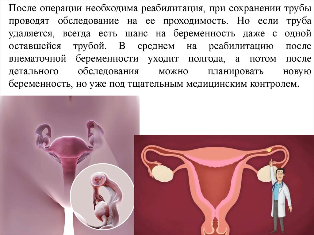 Забеременеть после внематочной беременности с одной трубой. Внематочная беременность. Внематочная беременность реабилитация. Реабилитация после внематочной беременности. Внематочная беременность операции реабилитация.