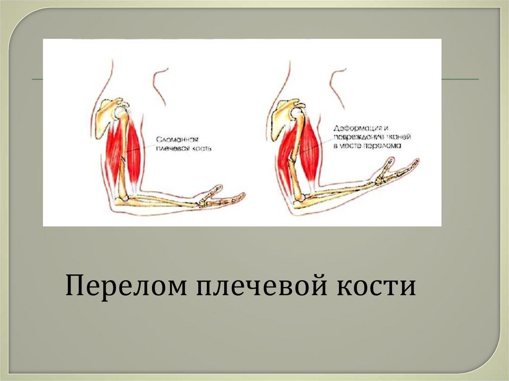 Презентация по теме первая помощь при ушибах переломах костей и вывихах суставов 8 класс