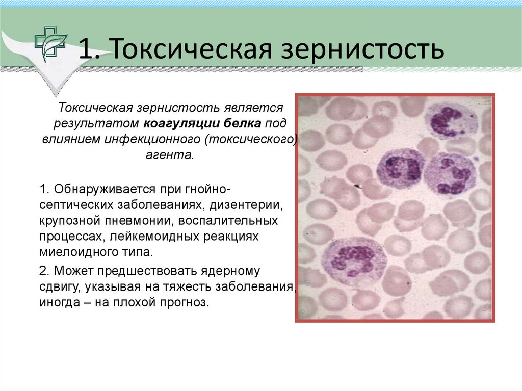 Изменения лейкоцитов в крови. Токсическая зернистость нейтрофилов. Лимфоциты токсогенная зернистость. Токсичная зернистость нейтрофилов. В мазке крови: токсигенная зернистость нейтрофилов.