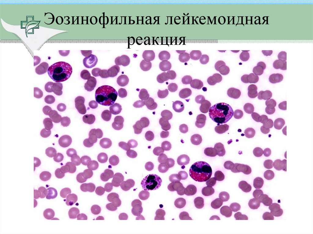 Лейкозы лейкемоидные реакции. Лейкемоидная реакция картина крови. Лейкемоидные реакции лимфоидного типа. Бластные клетки при лейкемоидной реакции.