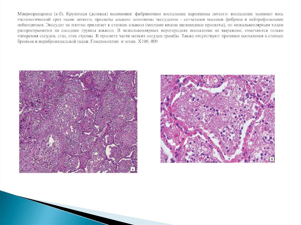 Крупозная пневмония патологическая анатомия презентация