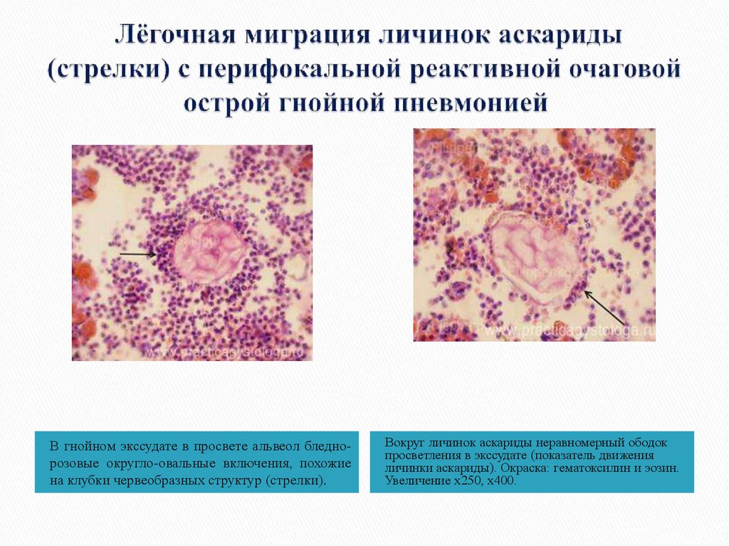 Виды экссудата при воспалении. Миграция личинок аскариды. Серозно лейкоцитарный экссудат. Микроскопия Гнойного экссудата.