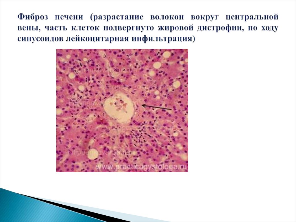 Фиброз печени (разрастание волокон вокруг центральной вены, часть клеток подвергнуто жировой дистрофии, по ходу синусоидов