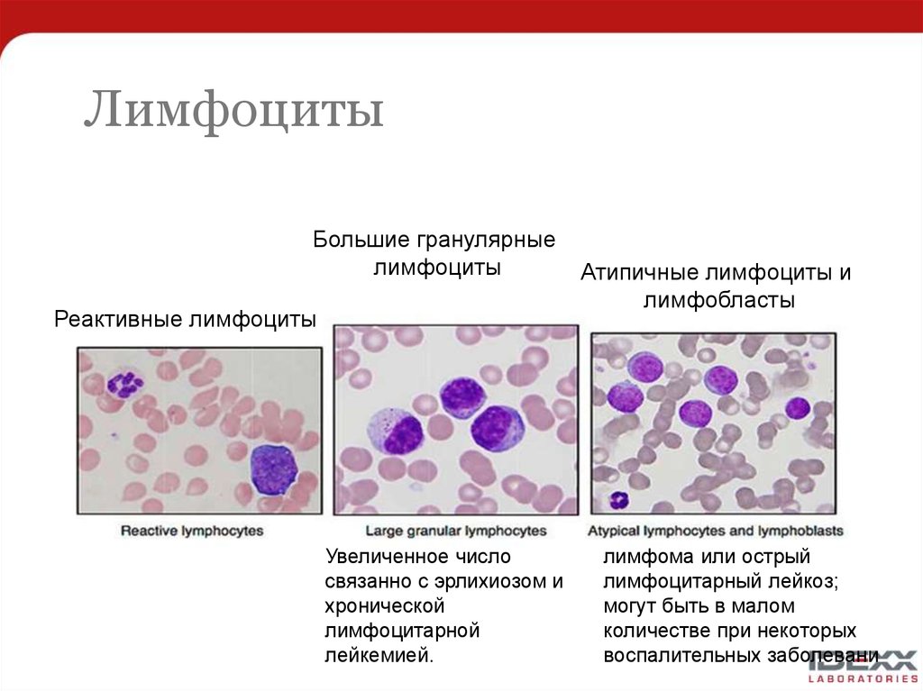 Что значит реактивные изменения клеток. Лимфоциты в периферической крови норма. Реактивные лимфоциты морфология. Клетки крови человека лимфоциты. Двухъядерные лимфоциты в крови.