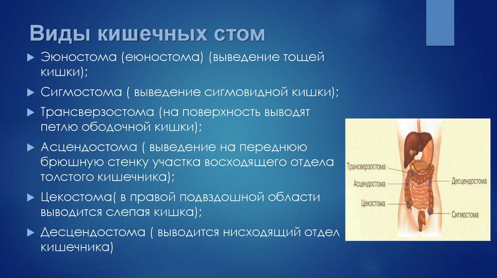 Классификация стом по прогнозу в плане хирургической реабилитации