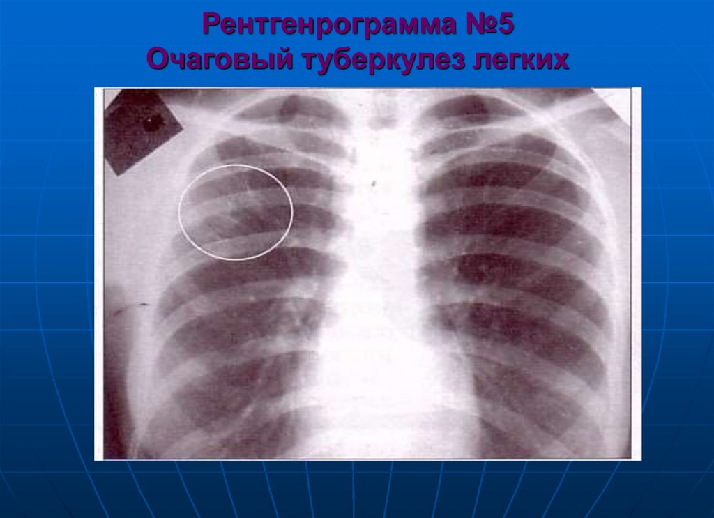 Рентгенрограмма №5 Очаговый туберкулез легких