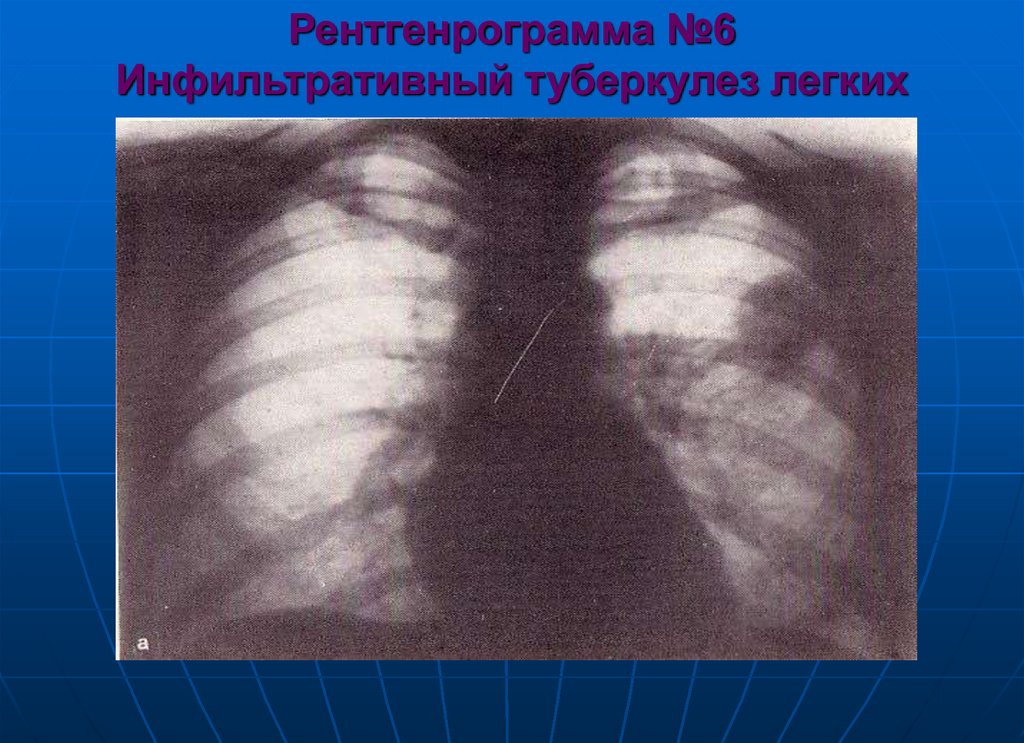 Рентгенрограмма №6 Инфильтративный туберкулез легких