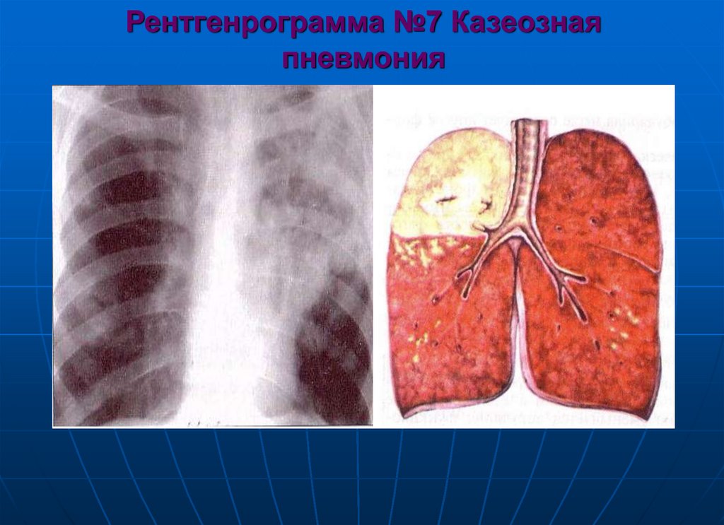 Казеозная пневмония презентация