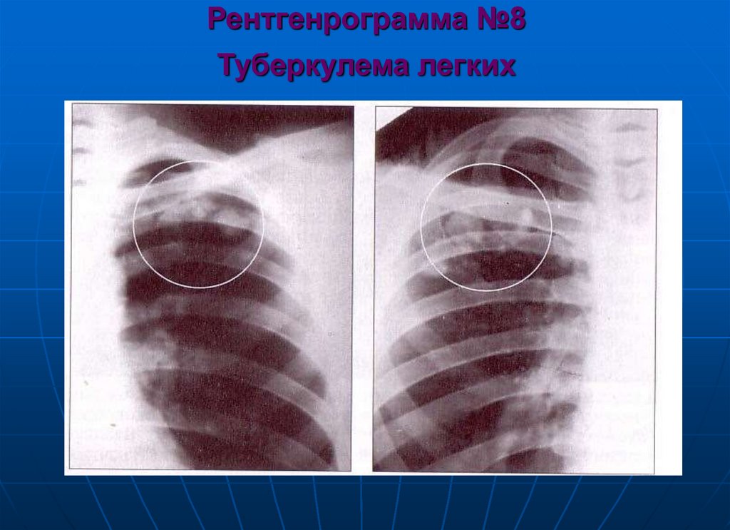 Рентгенрограмма №8 Туберкулема легких