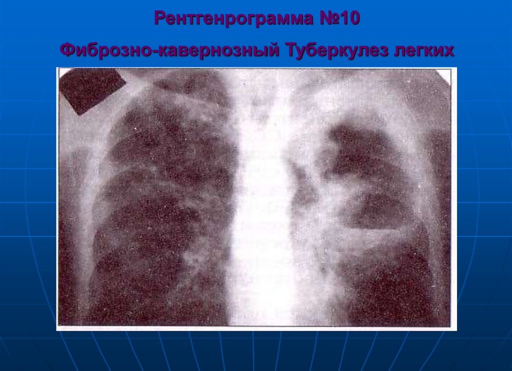 Рентгенрограмма №10 Фиброзно-кавернозный Туберкулез легких
