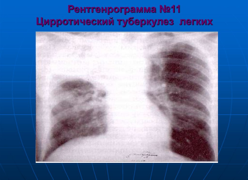 Рентгенрограмма №11 Цирротический туберкулез легких