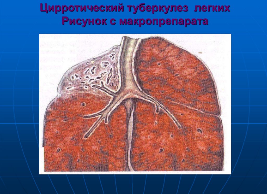 Цирротический туберкулез легких Рисунок с макропрепарата