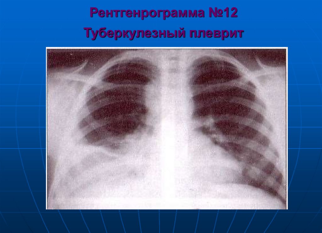 Рентгенрограмма №12 Туберкулезный плеврит