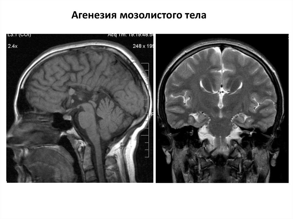 Агенезия это. Агенезия мозолистого тела на УЗИ фото.