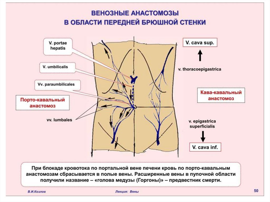 Стенка симптомы. Околопупочная Вена анастомозирует. Поверхностная надчревная Вена анастомоз. Боковой кава кавальный анастомоз. Кава кавальные анастомозы передней брюшной стенки.