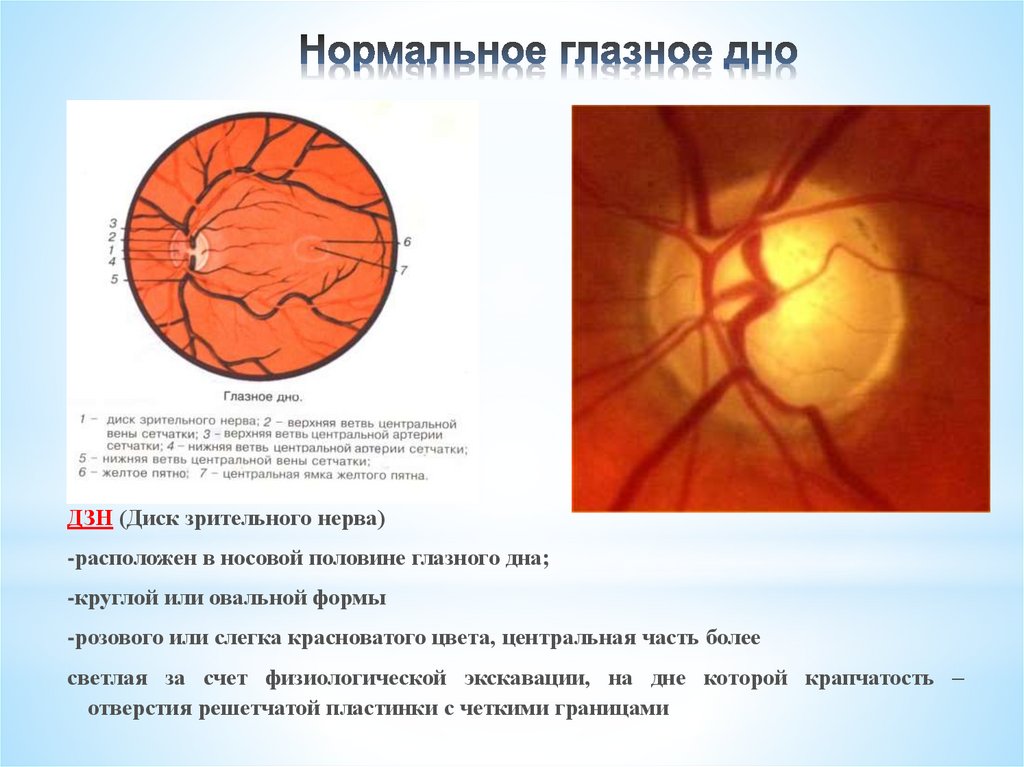 Норма зрительного нерва. ДЗН сосуды офтальмоскопия. Диск зрительного нерва норма офтальмолог. Исследование глазного дна норма. Схема глазного дна норма.