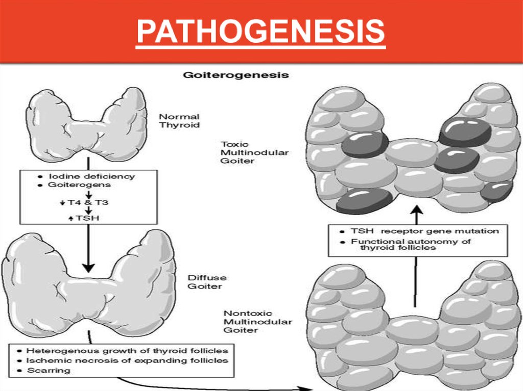 Toxic Multinodular Goiter Vs Graves Disease