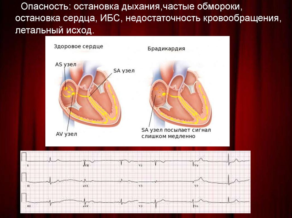 Нарушения ритма презентация