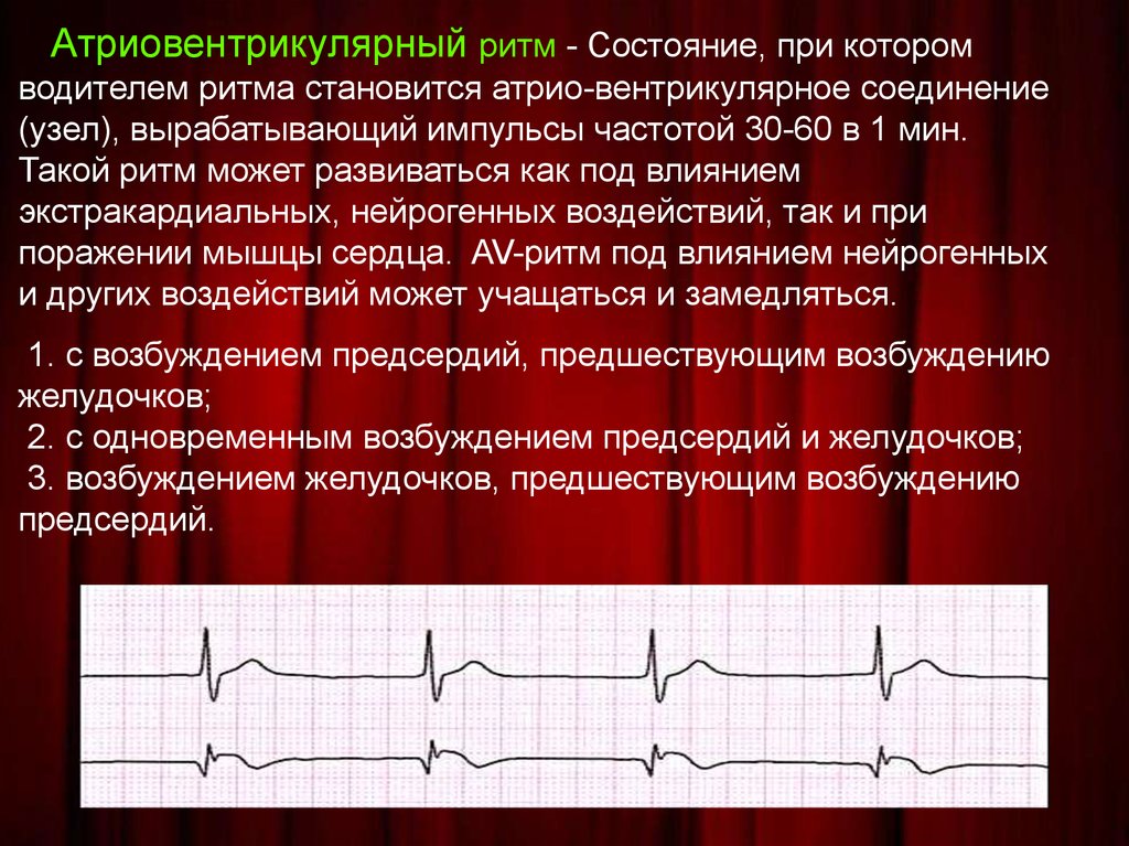 Нарушения ритма презентация